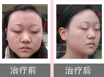 主页 扁平疣 扁平疣治疗     我院采用的中药无痕去疣疗法,采用我国